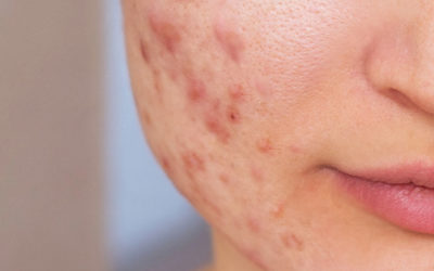 Causas del acné