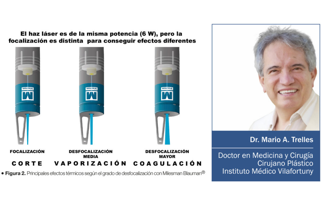 EVAlUATION OF A HIGH-POWER BLUE DIODE LASER (MILESMAN BLAUMAN®) FOR DEMAESTHETIC TREATMENTS.